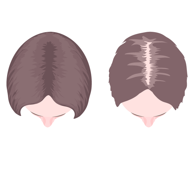Alopecia – Overview about the different forms of hair loss