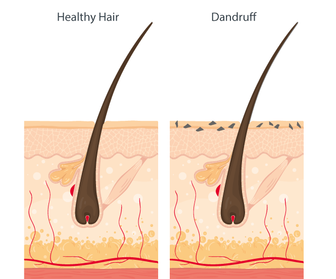 itchy scalp and dandruff)